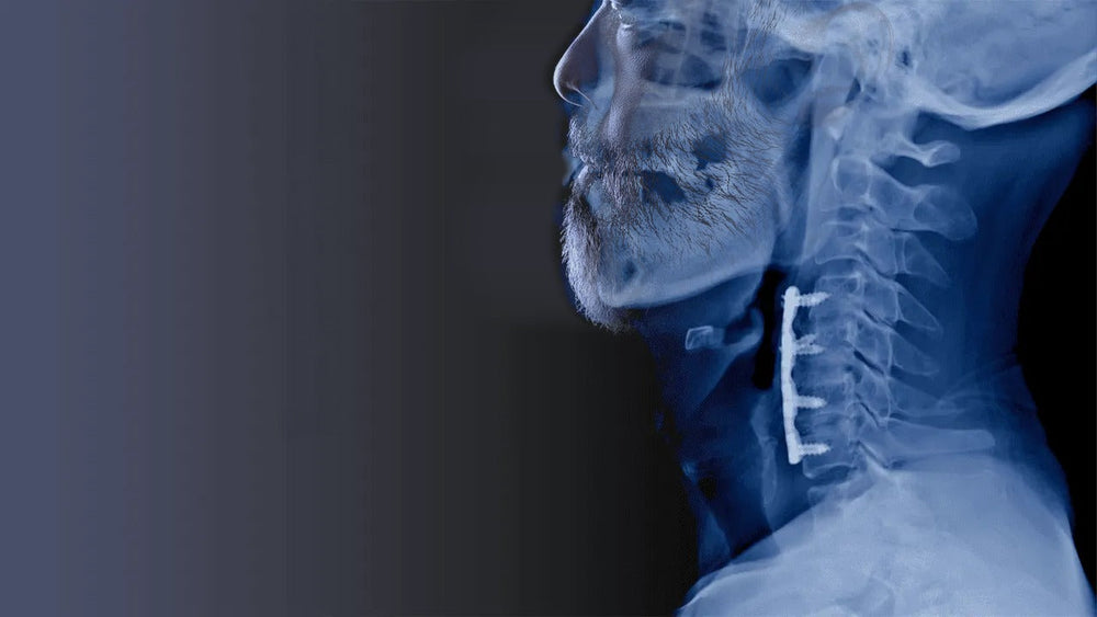 A man's face in profile merged with a lateral cervical spine X-ray showing the plate and screws from ACDF surgery.